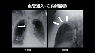 ⾎管迷⼊- 右内胸静脈
正⾯像 側⾯像
 