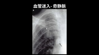 ⾎管迷⼊- 奇静脈
 