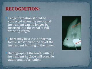 Ledge Radiograph procedural errors diagnosis and treatment | PPT