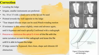 Ledge Radiograph Procedural Errors in Endodontics: Prevention & Management | PPTX