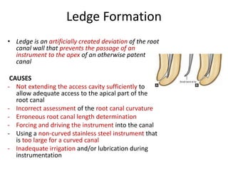 Ledge Rct Procedural Errors in Biomecanical Preparation | PPTX