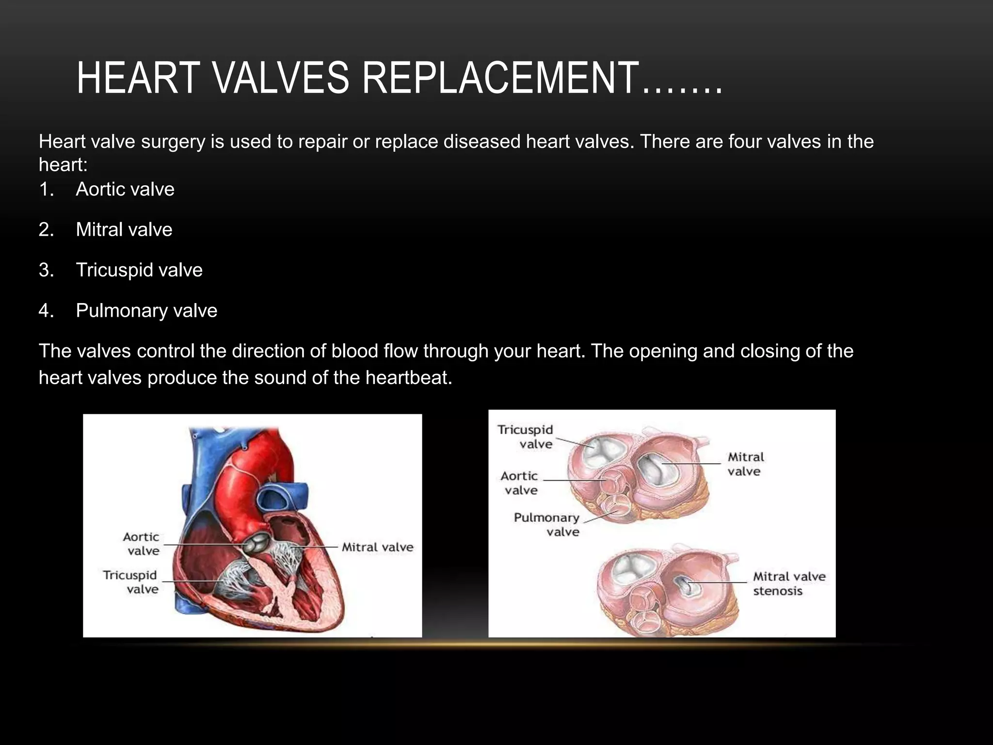 Heart Valves replacement…….Heart valve surgery is used to repair or replace diseased heart valves. There are four valves in the heart:Aortic valveMitral valveTricuspid valvePulmonary valveThe valves control the direction of blood flow through your heart. The opening and closing of the heart valves produce the sound of the heartbeat.