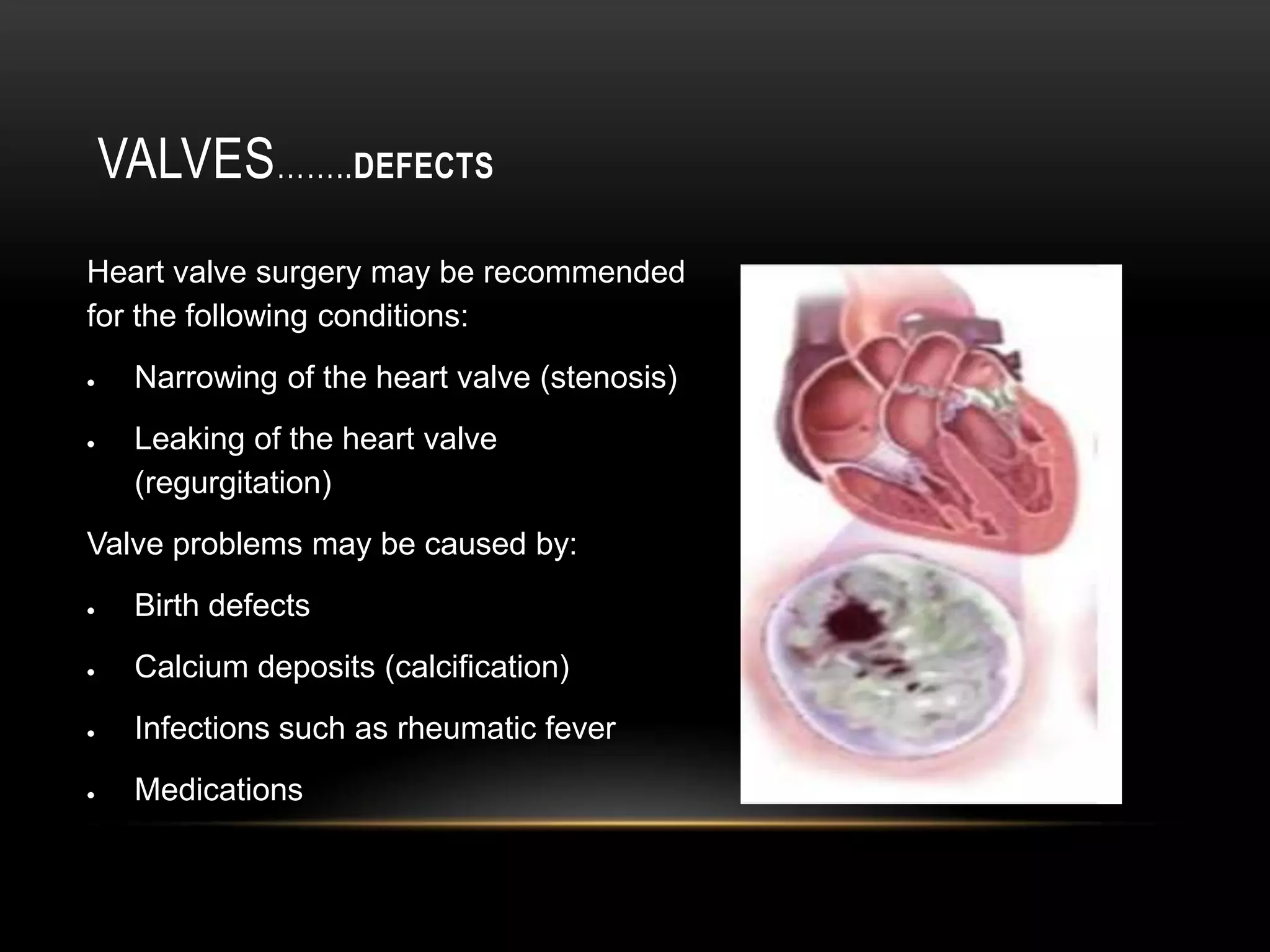 Valves……..DefectsHeart valve surgery may be recommended for the following conditions:Narrowing of the heart valve (stenosis)