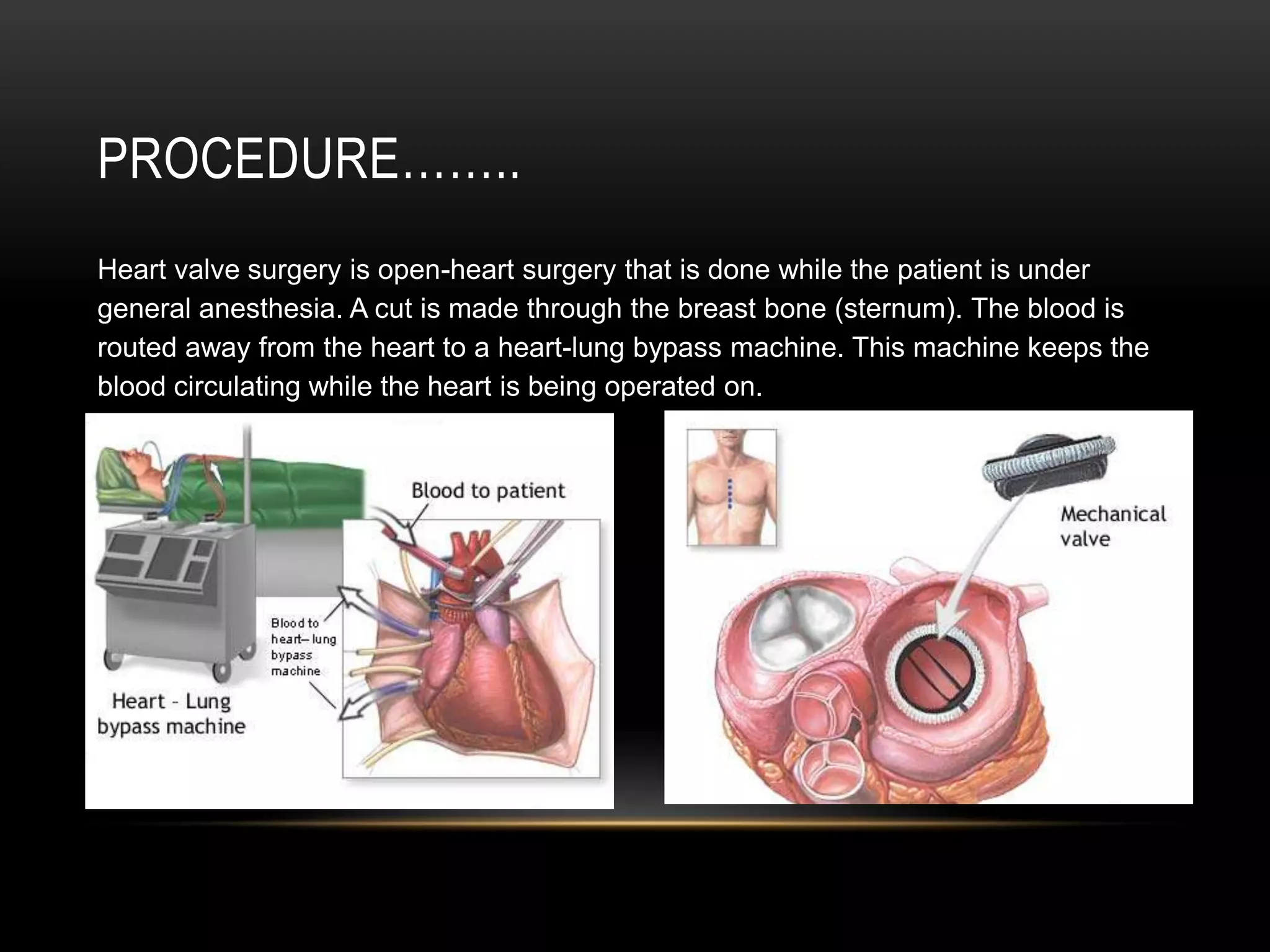 Leaking of the heart valve (regurgitation)Valve problems may be caused by:Birth defects
