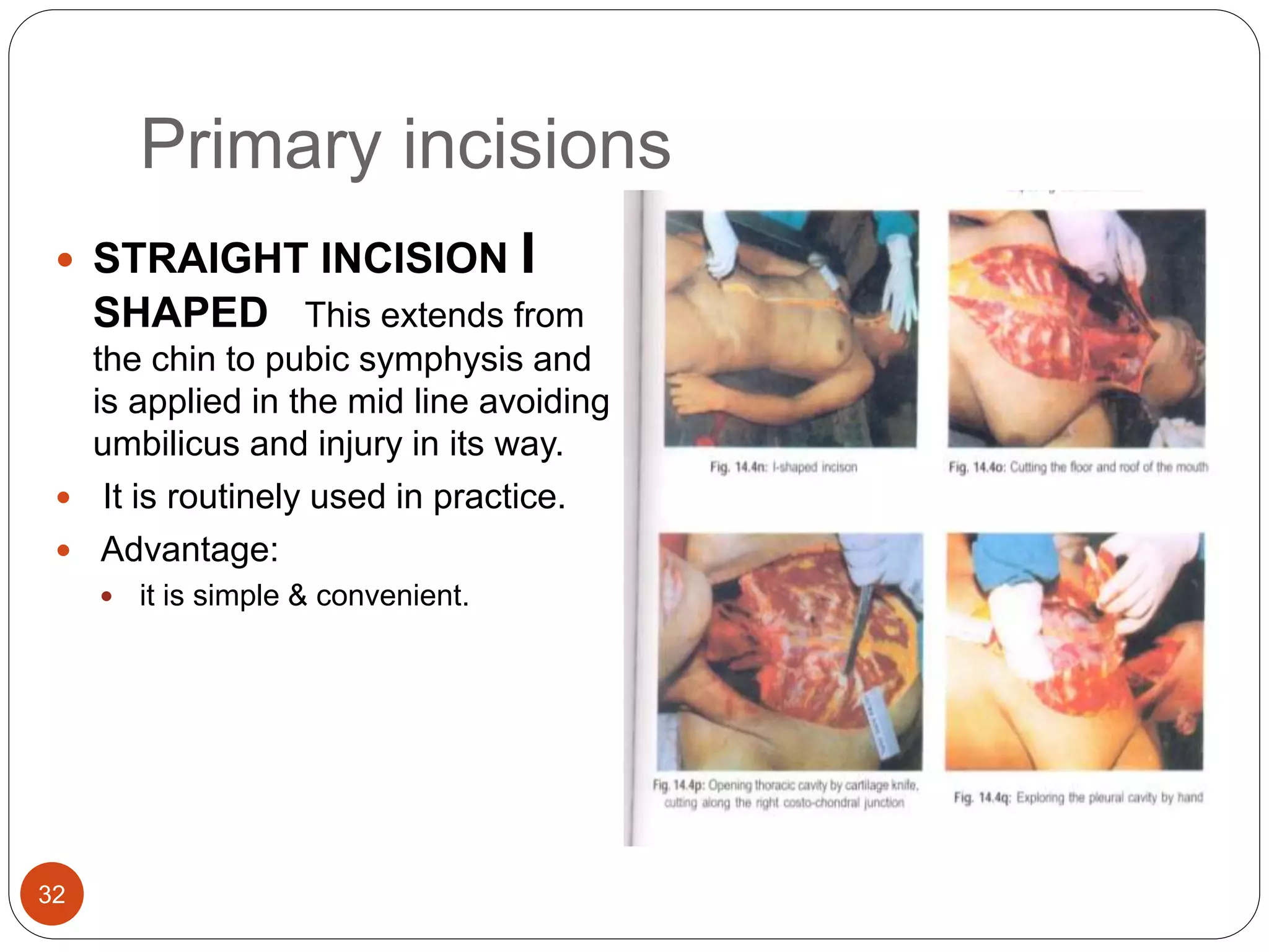 Primary incisions
32
 STRAIGHT INCISION I
SHAPED This extends from
the chin to pubic symphysis and
is applied in the mid line avoiding
umbilicus and injury in its way.
 It is routinely used in practice.
 Advantage:
 it is simple & convenient.
 