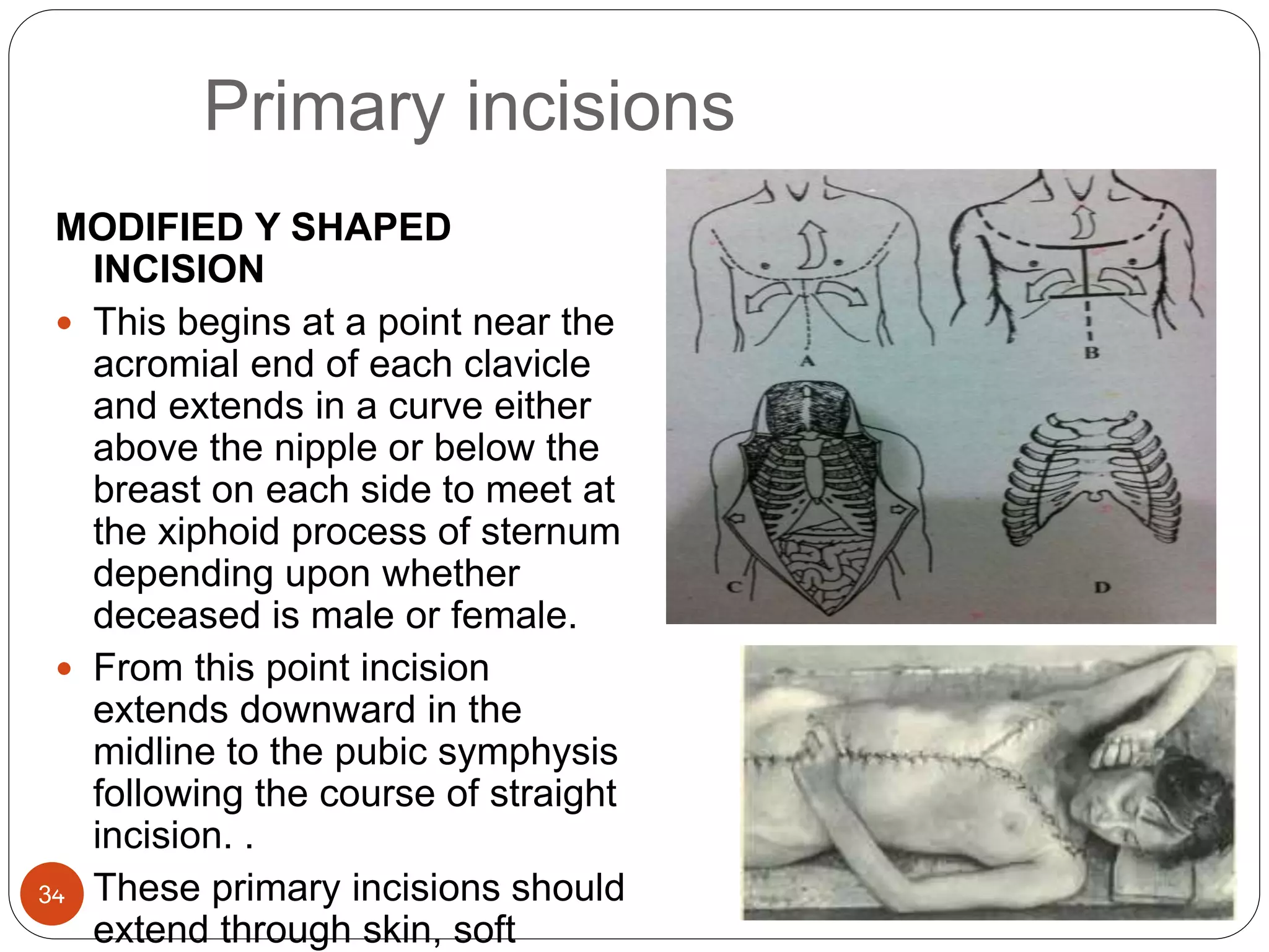 Primary incisions
34
MODIFIED Y SHAPED
INCISION
 This begins at a point near the
acromial end of each clavicle
and extends in a curve either
above the nipple or below the
breast on each side to meet at
the xiphoid process of sternum
depending upon whether
deceased is male or female.
 From this point incision
extends downward in the
midline to the pubic symphysis
following the course of straight
incision. .
 These primary incisions should
extend through skin, soft
 
