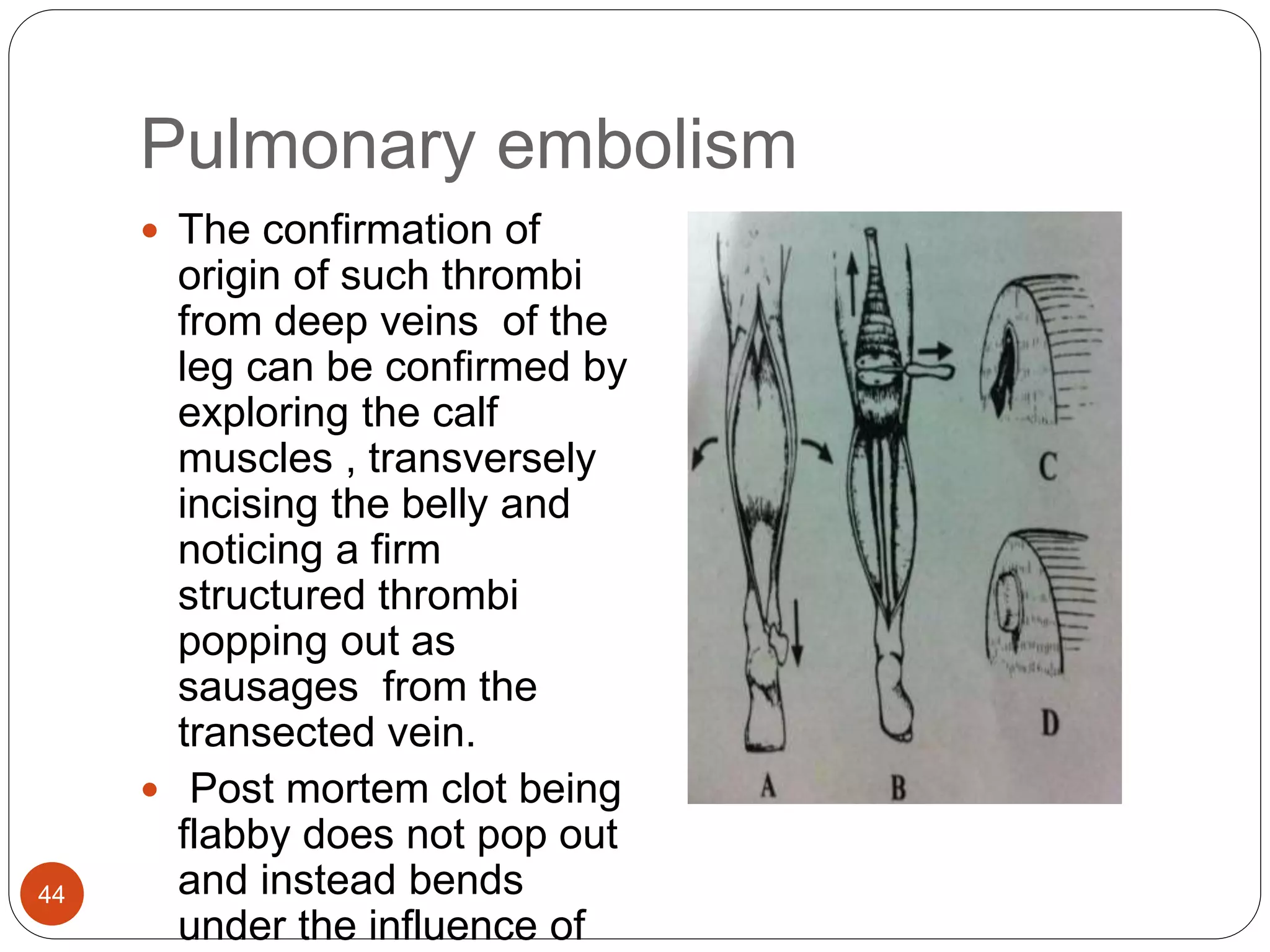 Pulmonary embolism
44
 The confirmation of
origin of such thrombi
from deep veins of the
leg can be confirmed by
exploring the calf
muscles , transversely
incising the belly and
noticing a firm
structured thrombi
popping out as
sausages from the
transected vein.
 Post mortem clot being
flabby does not pop out
and instead bends
under the influence of
 