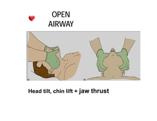 OPEN
AIRWAY
Head tilt, chin lift + jaw thrust
 
