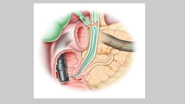 Procedure of ercp and t tube cholangiography | PPTX
