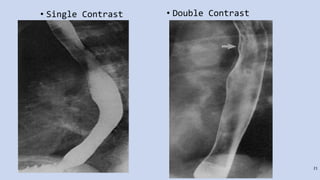 21
• Single Contrast • Double Contrast
 