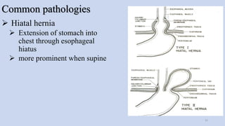 Common pathologies
 Hiatal hernia
 Extension of stomach into
chest through esophageal
hiatus
 more prominent when supine
31
 