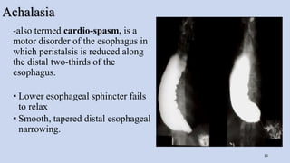 Achalasia
-also termed cardio-spasm, is a
motor disorder of the esophagus in
which peristalsis is reduced along
the distal two-thirds of the
esophagus.
• Lower esophageal sphincter fails
to relax
• Smooth, tapered distal esophageal
narrowing.
33
 