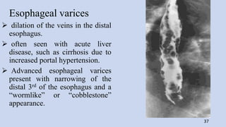 Esophageal varices
 dilation of the veins in the distal
esophagus.
 often seen with acute liver
disease, such as cirrhosis due to
increased portal hypertension.
 Advanced esophageal varices
present with narrowing of the
distal 3rd of the esophagus and a
“wormlike” or “cobblestone”
appearance.
37
 