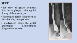 GERD
the entry of gastric contents
into the esophagus, irritating the
lining of the esophagus.
Esophageal reflux is reported as
heartburn by most patients.
In advanced cases, the distal
esophagus demonstrates
longitudinal streaks
38
 