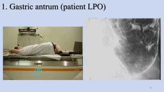 1. Gastric antrum (patient LPO)
58
 