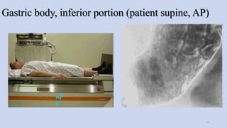 Gastric body, inferior portion (patient supine, AP)
59
 