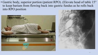 • Gastric body, superior portion (patient RPO). (Elevate head of table 15°
to keep barium from flowing back into gastric fundus as he rolls back
into RPO position
61
 