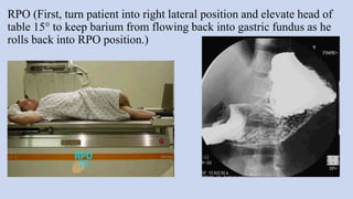 RPO (First, turn patient into right lateral position and elevate head of
table 15° to keep barium from flowing back into gastric fundus as he
rolls back into RPO position.)
 