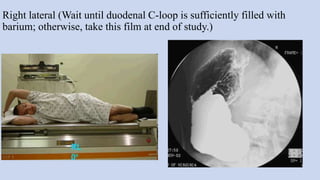 Right lateral (Wait until duodenal C-loop is sufficiently filled with
barium; otherwise, take this film at end of study.)
 