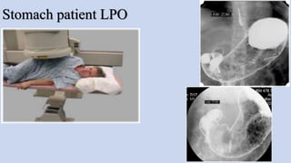 Stomach patient LPO
 