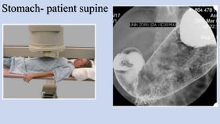 Stomach- patient supine
 