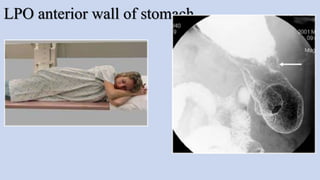 LPO anterior wall of stomach
 