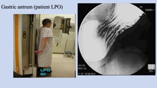 Gastric antrum (patient LPO)
 
