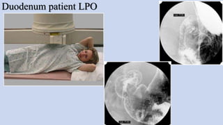 Duodenum patient LPO
 
