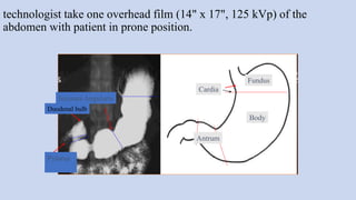 technologist take one overhead film (14" x 17", 125 kVp) of the
abdomen with patient in prone position.
Incisura Angularis
Fundus
Body
Antrum
Pylorus
Cardia
Duodenal bulb
 