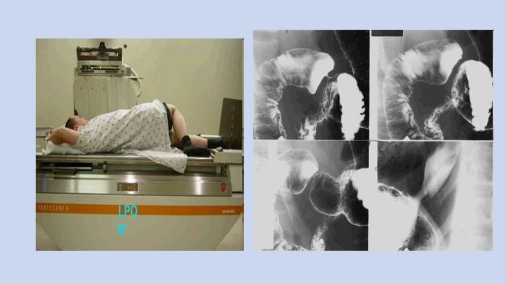 Procedure of upper gi