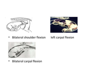 • Bilateral shoulder flexion left carpal flexion
• Bilateral carpal flexion
 