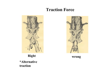 Traction Force
Right
*Alternative
traction
wrong
 