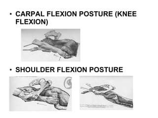 • CARPAL FLEXION POSTURE (KNEE
FLEXION)
• SHOULDER FLEXION POSTURE
 