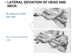 • LATERAL DEVIATION OF HEAD AND
NECK
By using eye hooks
and rope
By using mandibular
robe
 