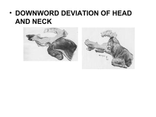 • DOWNWORD DEVIATION OF HEAD
AND NECK
 