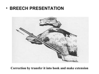 • BREECH PRESENTATION
Correction by transfer it into hook and make extension
 