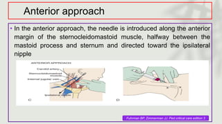 Anterior approach
• In the anterior approach, the needle is introduced along the anterior
margin of the sternocleidomastoid muscle, halfway between the
mastoid process and sternum and directed toward the ipsilateral
nipple
Fuhrman BP, Zimmerman JJ. Ped critical care edition 3
 