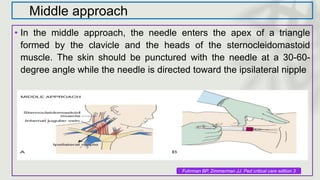 Middle approach
• In the middle approach, the needle enters the apex of a triangle
formed by the clavicle and the heads of the sternocleidomastoid
muscle. The skin should be punctured with the needle at a 30-60-
degree angle while the needle is directed toward the ipsilateral nipple
Fuhrman BP, Zimmerman JJ. Ped critical care edition 3
 