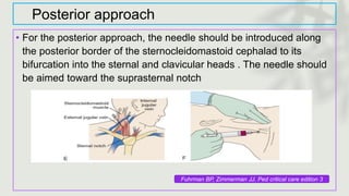 Posterior approach
• For the posterior approach, the needle should be introduced along
the posterior border of the sternocleidomastoid cephalad to its
bifurcation into the sternal and clavicular heads . The needle should
be aimed toward the suprasternal notch
Fuhrman BP, Zimmerman JJ. Ped critical care edition 3
 
