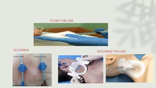 FLUSH THE LINE
SUTURING SECURING THE LINE
 