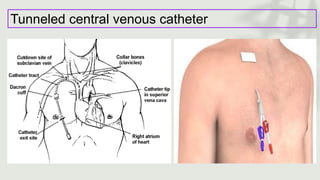 Tunneled central venous catheter
 