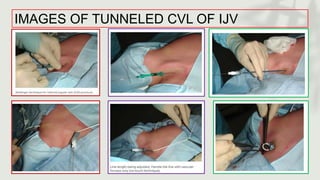 IMAGES OF TUNNELED CVL OF IJV
 