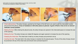 ◦ Chest wall puncture: The artery forceps, guarded by the fingers of the left hand, are used to split the intercostal muscles
and puncture the pleura. A loss of resistance is felt when pleura is pierced. A gush of fluid or hiss of air on removal
indicates correct position
◦ Dilating the tract: After entering the pleural cavity, the artery forceps are opened in the intercostal space to increase the size
of the opening
◦ Dilating the tract: The artery forceps are rotated 90 degrees and again opened to increase the size of the opening
◦ Grasping the chest tube: The chest tube is held by an artery forceps just proximal to its tip
◦ Inserting the tube: The tube held in the artery forceps is inserted into the pleural space. The tip of the artery forceps should
be proximal to the tip of the chest tube and should never protrude beyond it
Safe insertion of a chest tube- National Medical Journal of India- Vol 22.No 4 2009
The Harriet Lane Handbook for Pediatric House Officers
 