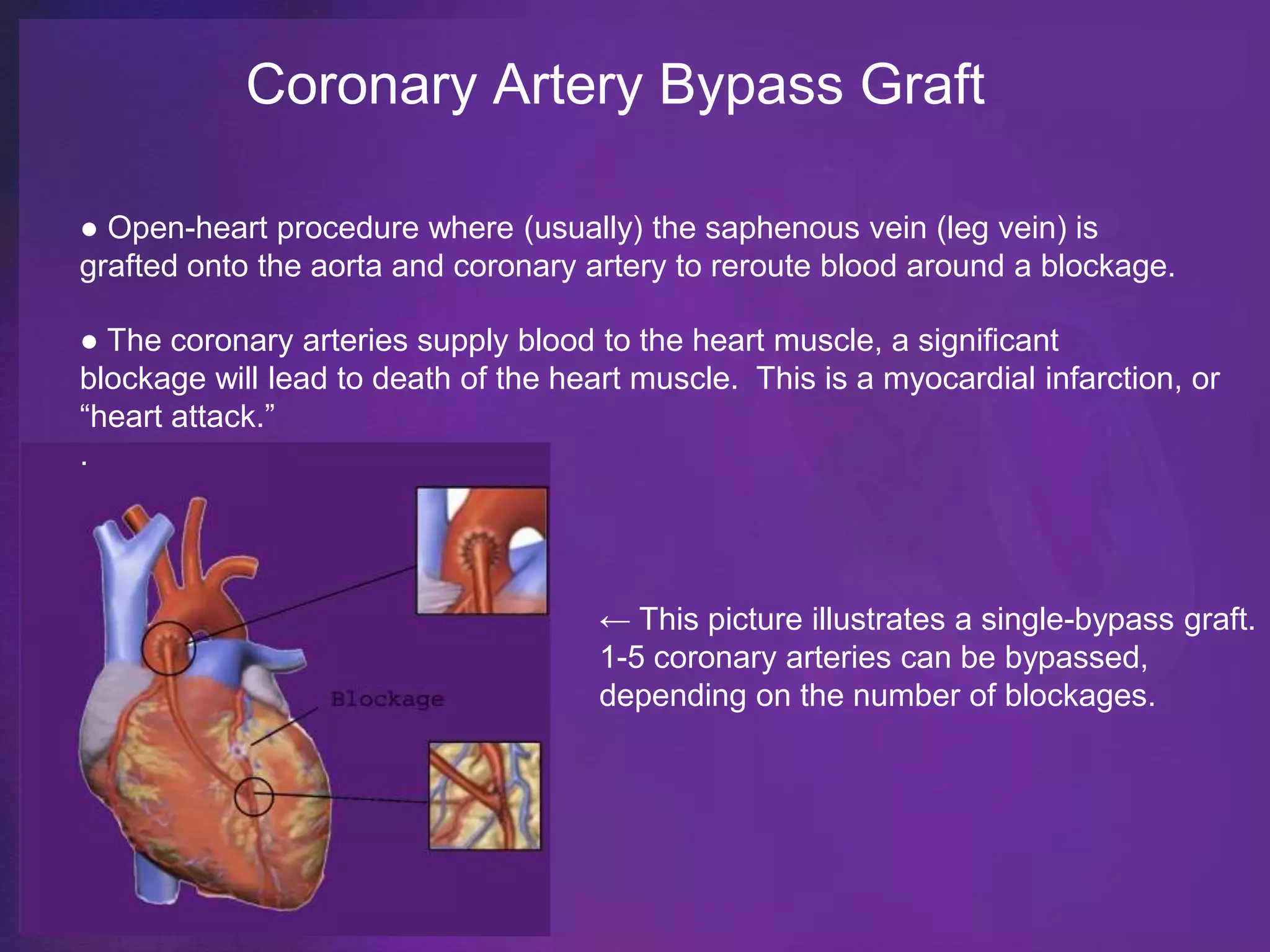 Coronary Artery Bypass Graft

● Open-heart procedure where (usually) the saphenous vein (leg vein) is
grafted onto the aorta and coronary artery to reroute blood around a blockage.

● The coronary arteries supply blood to the heart muscle, a significant
blockage will lead to death of the heart muscle. This is a myocardial infarction, or
“heart attack.”
.




                                      ← This picture illustrates a single-bypass graft.
                                      1-5 coronary arteries can be bypassed,
                                      depending on the number of blockages.
 