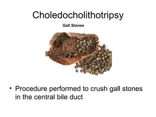 Choledocholithotripsy
                Gall Stones




• Procedure performed to crush gall stones
  in the central bile duct
 