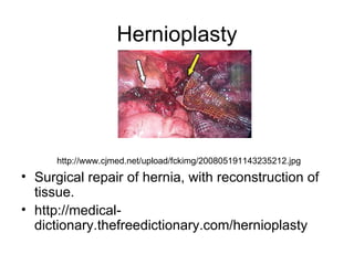 Hernioplasty




      http://www.cjmed.net/upload/fckimg/200805191143235212.jpg
• Surgical repair of hernia, with reconstruction of
  tissue.
• http://medical-
  dictionary.thefreedictionary.com/hernioplasty
 