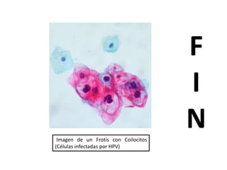 FIN Imagen de un Frotis con Coilocitos (Células infectadas por HPV)