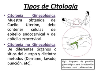 Tipos de CitologíaCitología Ginecológica: Muestra obtenida del Cuello Uterino, debe contener células del epitelio endocervical y del epitelio exocervical.Citología no Ginecológica: De diferentes órganos o sitios del cuerpo y distintos métodos (Derrame, lavado, punción, etc).Fig1: Esquema de posición ginecológica para la obtención de muestra del cuello uterino