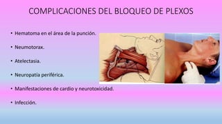 COMPLICACIONES DEL BLOQUEO DE PLEXOS
• Hematoma en el área de la punción.
• Neumotorax.
• Atelectasia.
• Neuropatía periférica.
• Manifestaciones de cardio y neurotoxicidad.
• Infección.
 