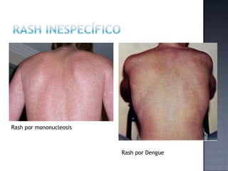 Rash por mononucleosis
Rash por Dengue
 